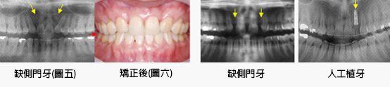 兒童牙醫-缺牙